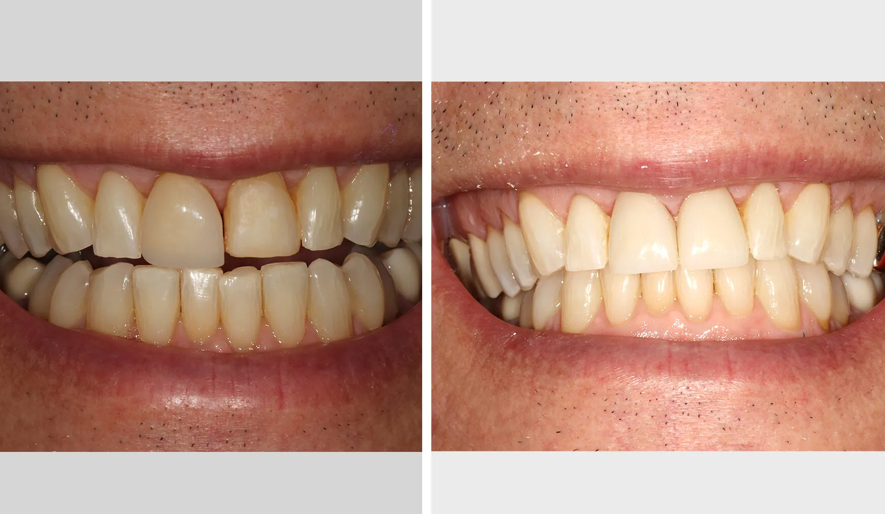 Case 5: before and after