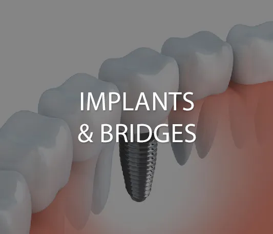 Implants and bridges